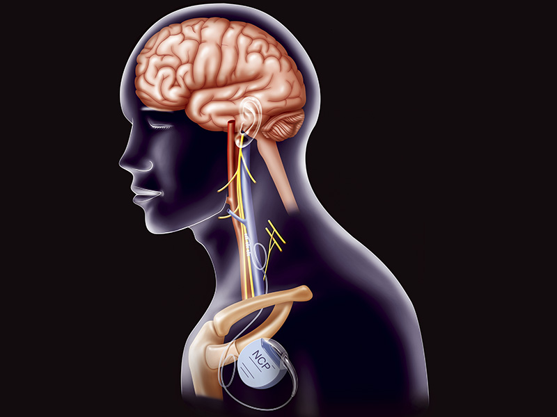 Plano de saúde deve custear cirurgia de epilepsia