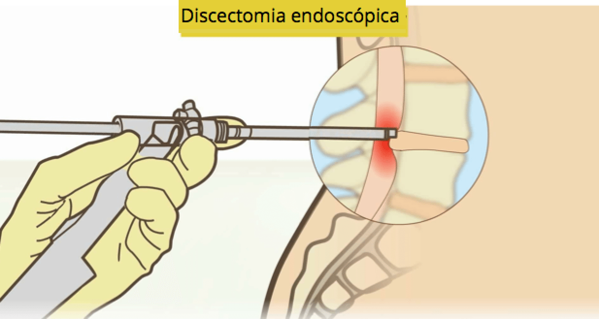 DISCECTOMIA ENDOSCÓPICA - Plano de saúde é obrigado a custear tratamento