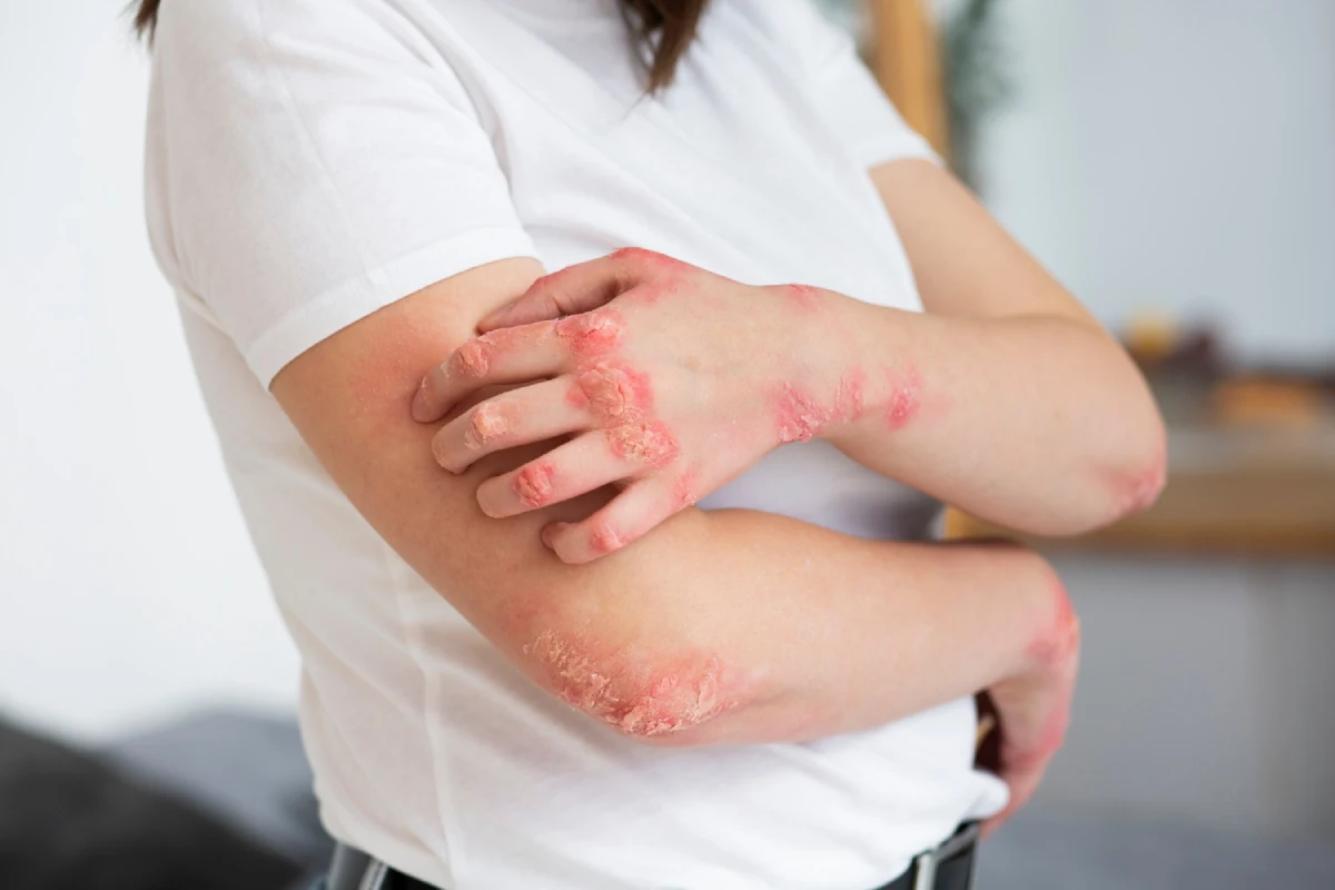 tratamento para dermatite atópica pelo plano de saúde