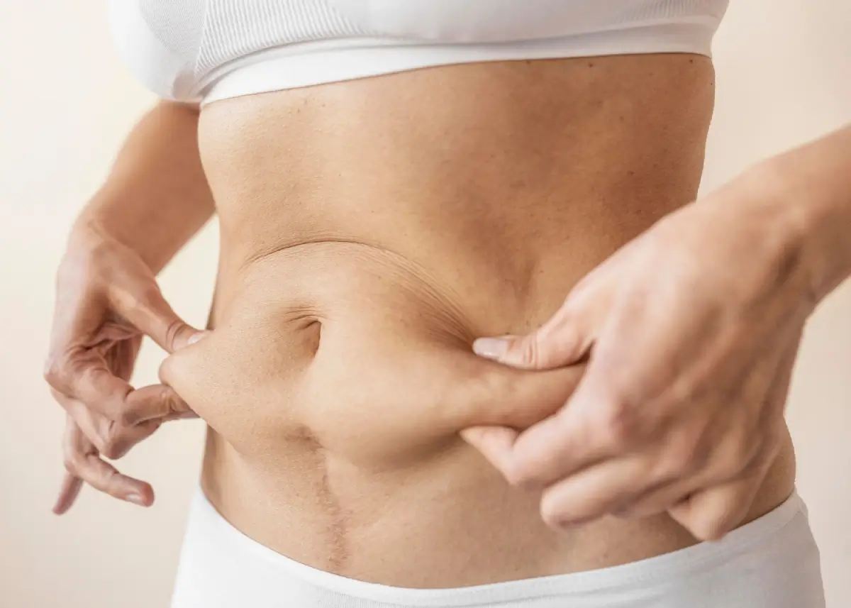 Abdominoplastia pelo plano de saúde